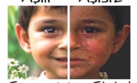 Kızamık Hastalığı